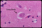 Dementia with Lewy Bodies