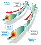 Multiple Sclerosis