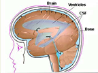 Normal Pressure Hydrocephalus 